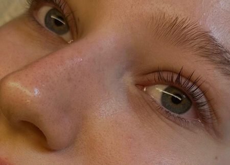 Browlifting